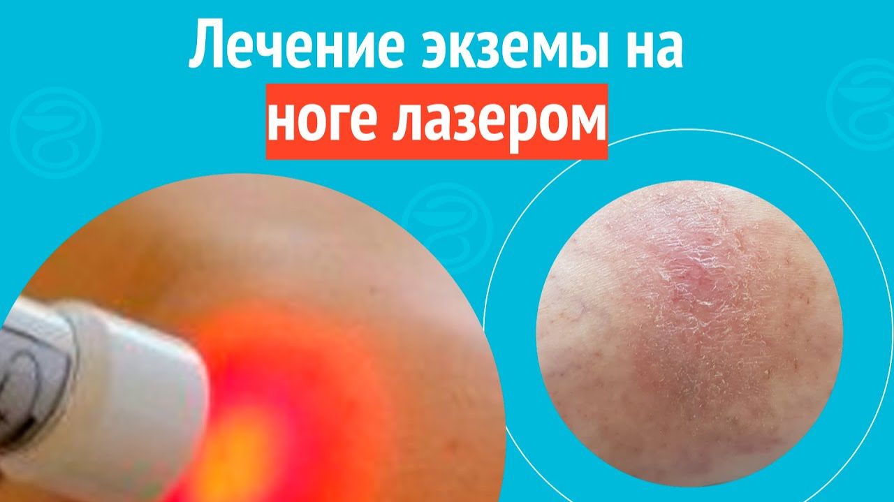 🦵 Лечение экземы на ноге лазером. Клинический случай №1567 смотреть онлайн