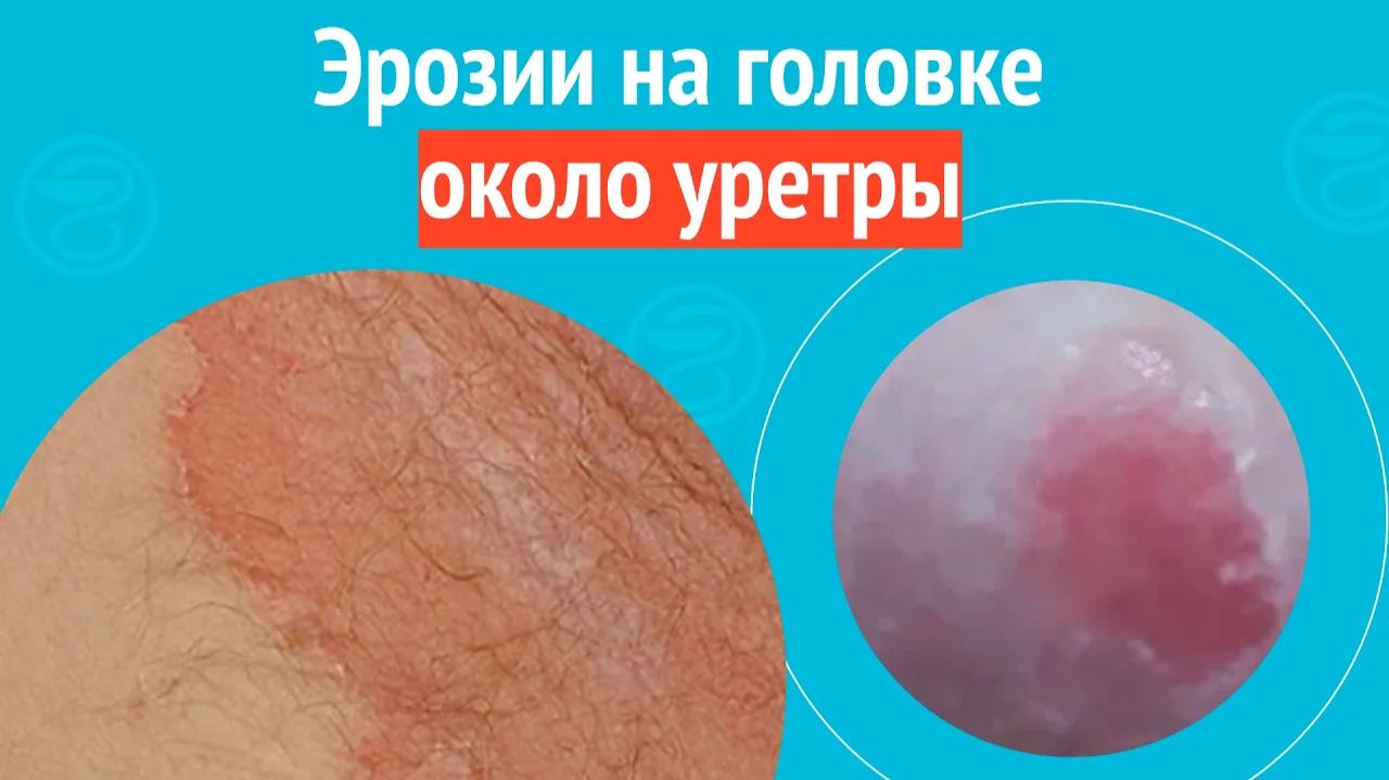 🤨 Эрозии на головке около уретры. Клинический случай №1557 смотреть онлайн