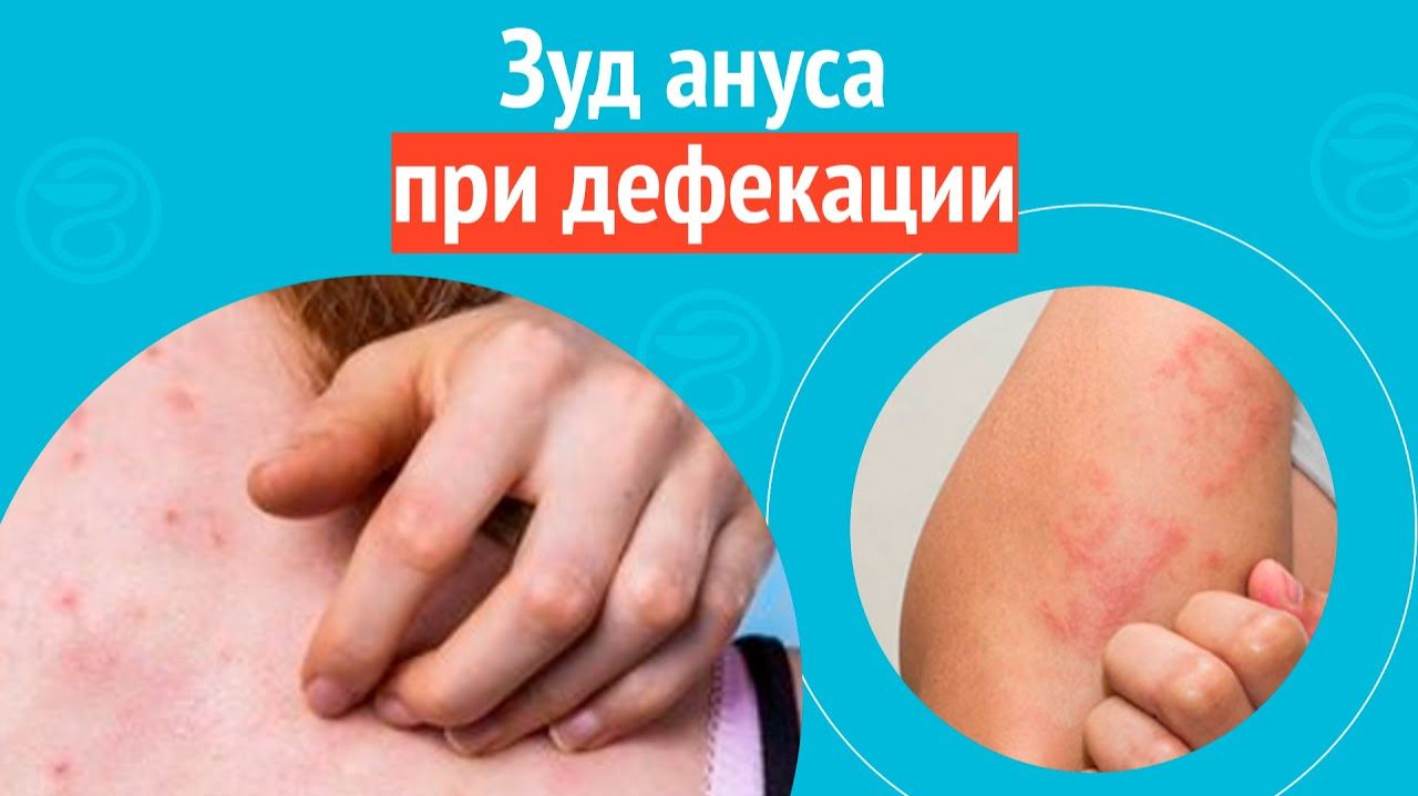 👉 Зуд ануса при дефекации. Клинический случай №1551 смотреть онлайн