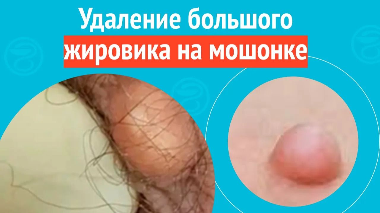 ✅ Удаление большого жировика на мошонке. Клинический случай №1543 смотреть онлайн