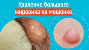 ✅ Удаление большого жировика на мошонке. Клинический случай №1543