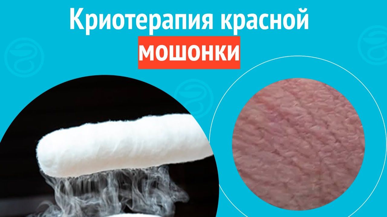 ✅ Криотерапия красной мошонки. Клинический случай №1560 смотреть онлайн