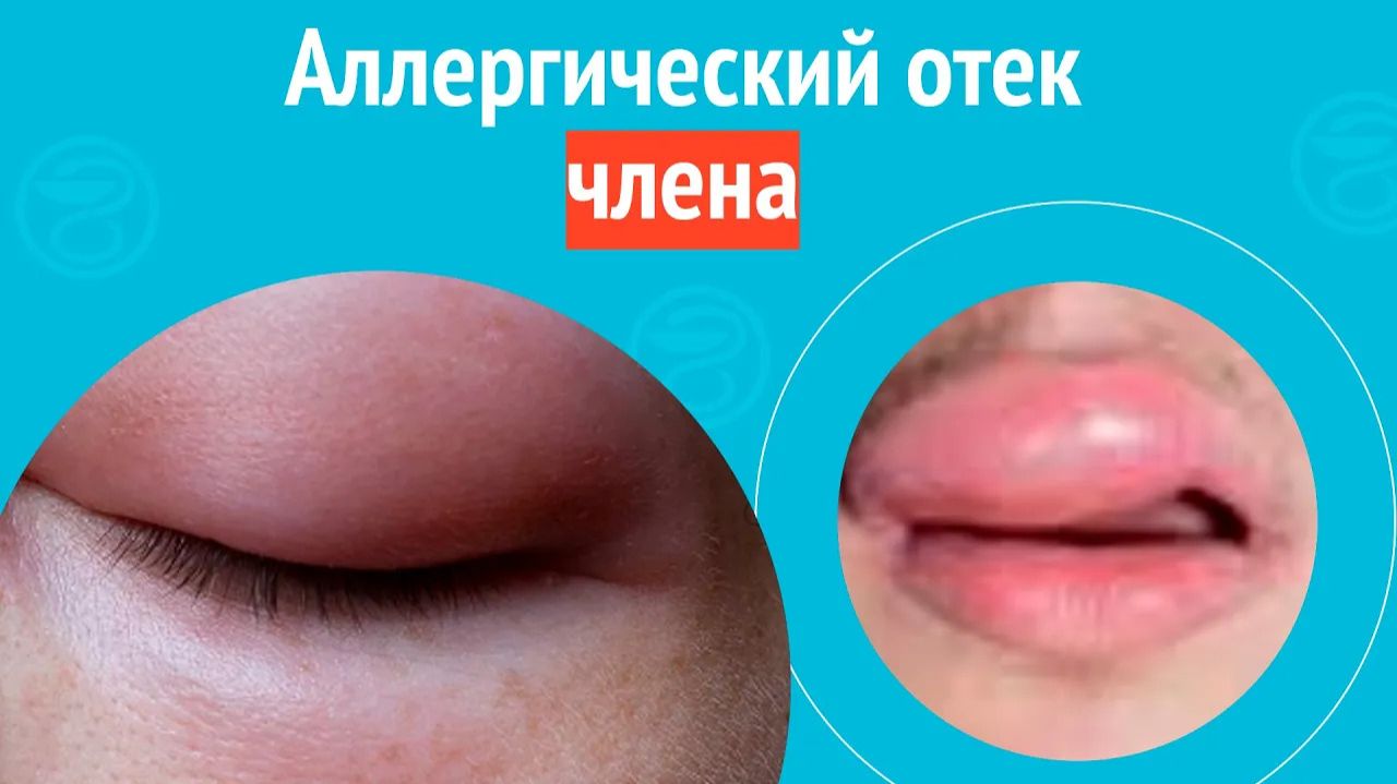 👉 Аллергический отек члена. Клинический случай №1568 смотреть онлайн