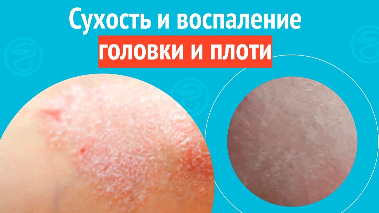🥺 Сухость и воспаление головки и плоти. Клинический случай №1553 смотреть онлайн