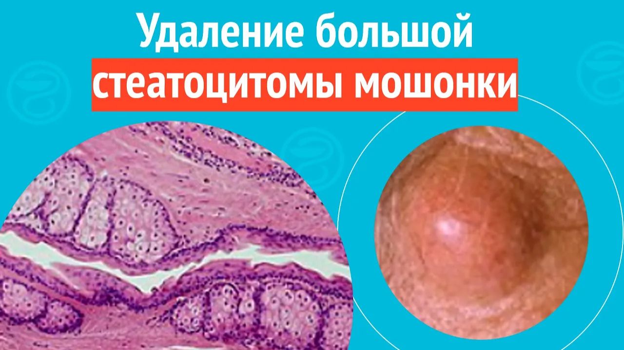 ➡️ Удаление большой стеатоцитомы мошонки. Клинический случай №1555 смотреть онлайн