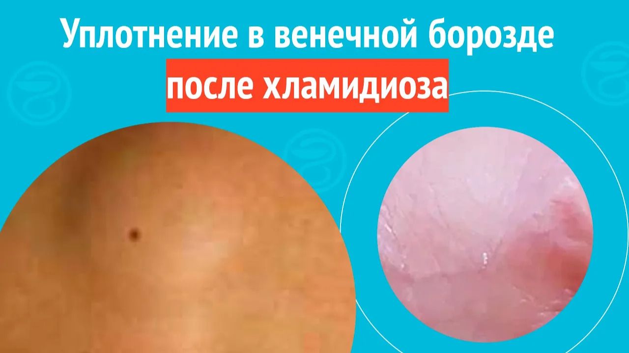 👉 Уплотнение в венечной борозде после хламидиоза. Клинический случай №1544 смотреть онлайн