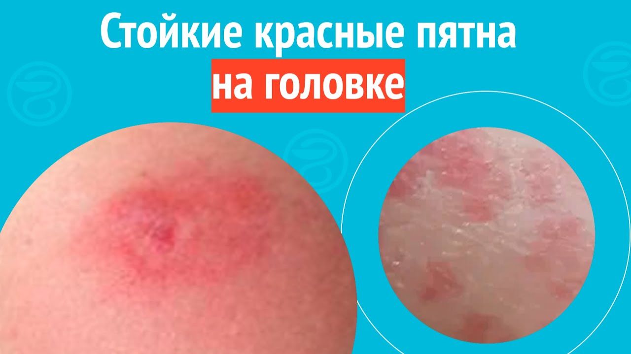 😡 Стойкие красные пятна на головке. Клинический случай №1549 смотреть онлайн