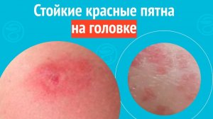 😡 Стойкие красные пятна на головке. Клинический случай №1549