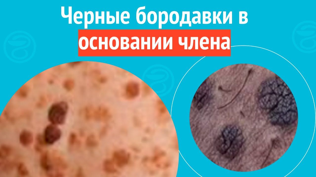 😦 Черные бородавки в основании члена. Клинический случай №1580 смотреть онлайн