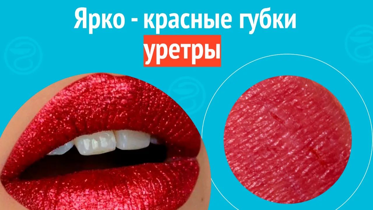 👄 Ярко - красные губки уретры. Клинический случай №1573 смотреть онлайн