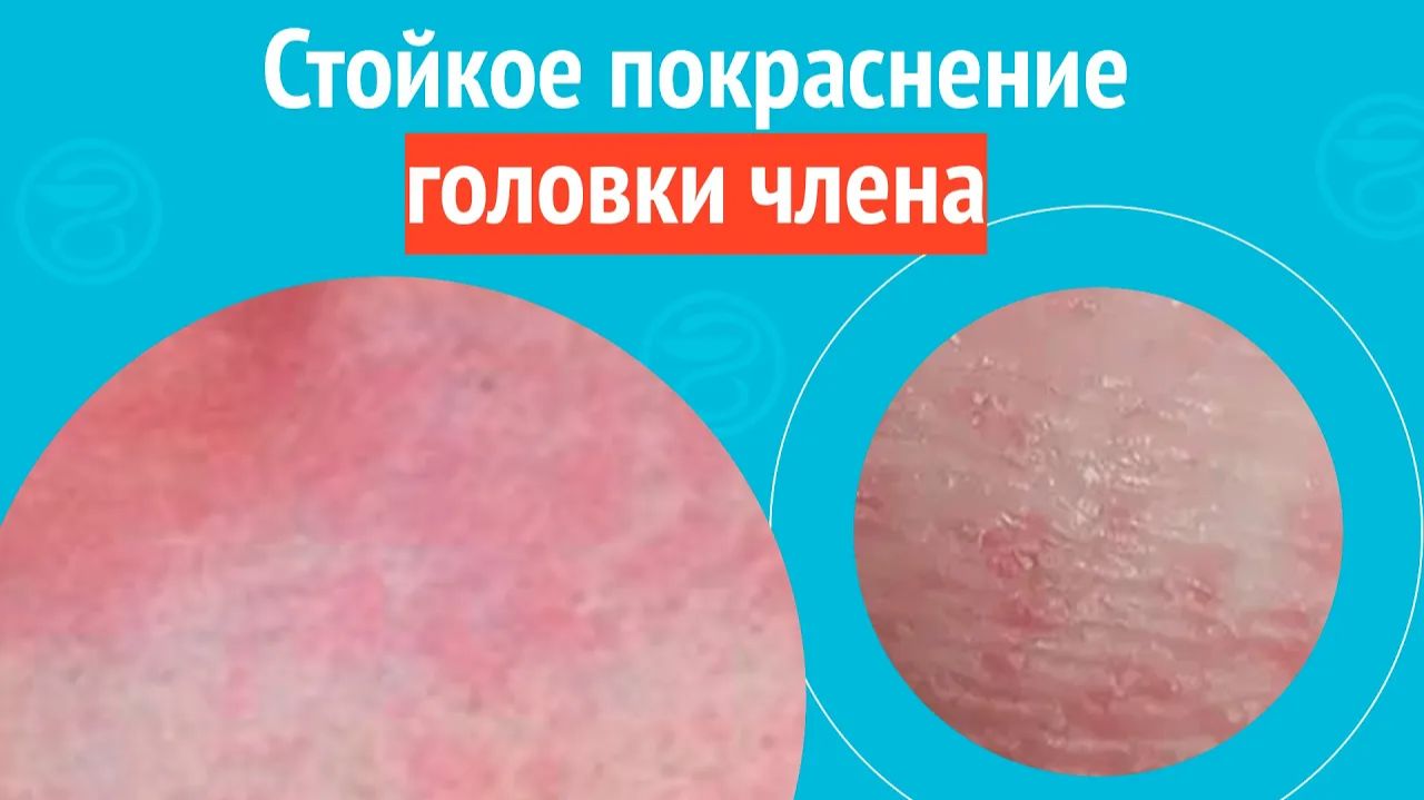 😡 Стойкое покраснение головки члена. Клинический случай №1592 смотреть онлайн