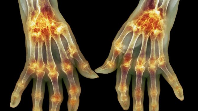 Ревматоидный артрит и беременность смотреть онлайн