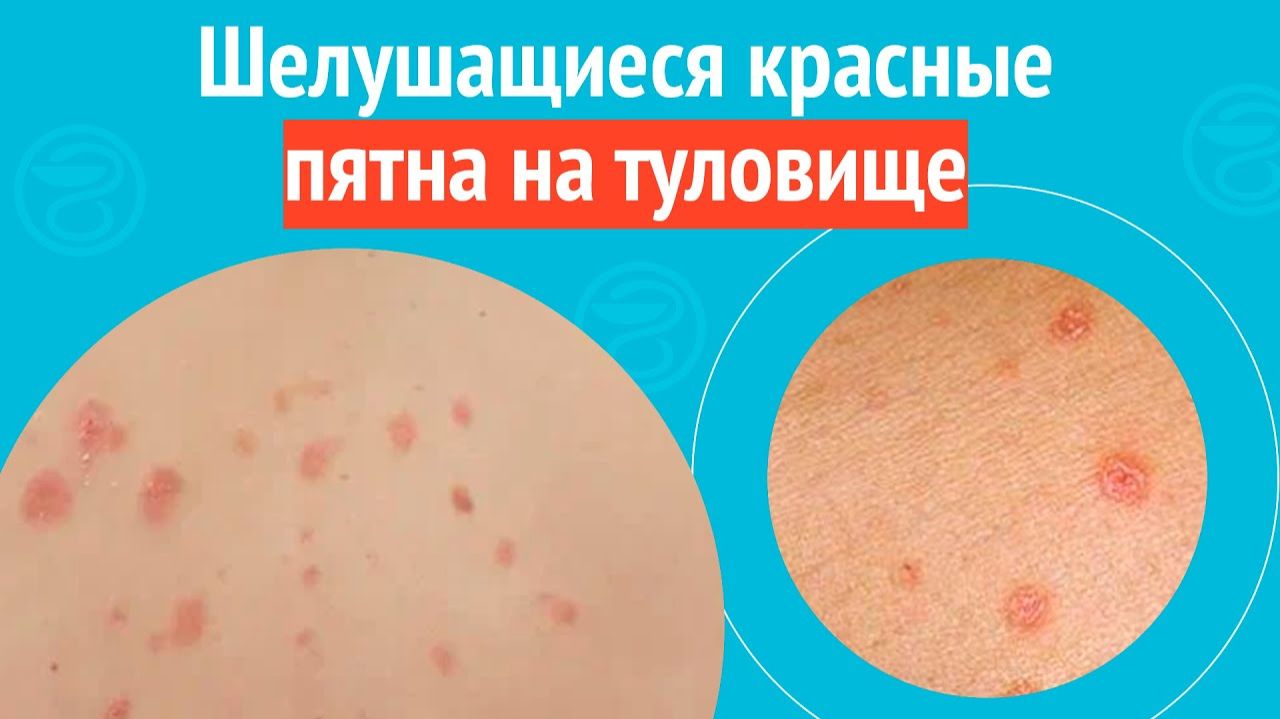 🥺 Шелушащиеся красные пятна на туловище. Клинический случай №1586 смотреть онлайн
