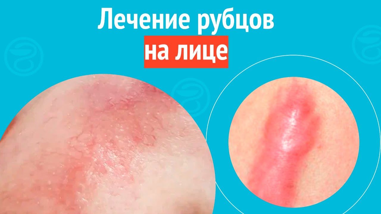 👃 Лечение рубцов на лице. Клинический случай №1591 смотреть онлайн