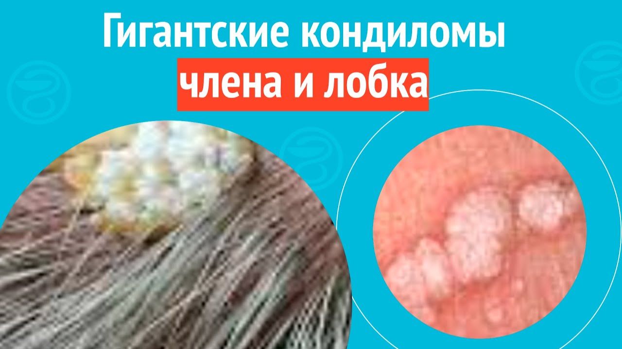 😱 Гигантские кондиломы члена и лобка. Клинический случай №1585 смотреть онлайн