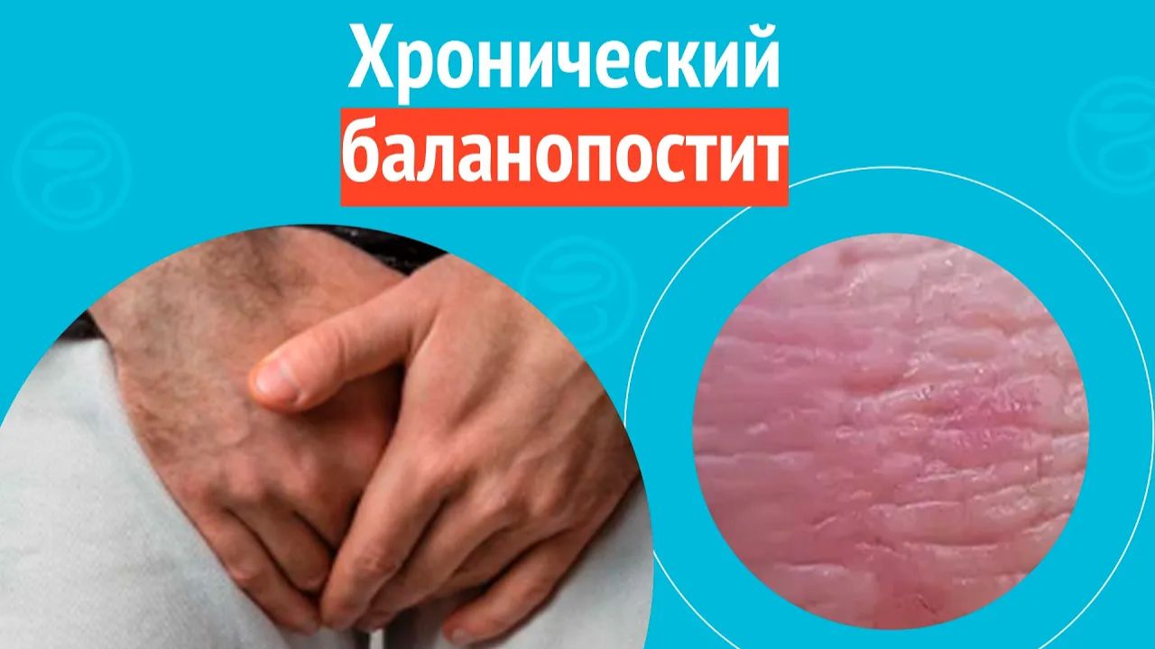 😯 Хронический баланопостит. Клинический случай №1576 смотреть онлайн