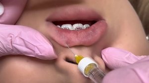 Губы чайка | Схема увеличения за одну процедуру без заворачиваний и миграций