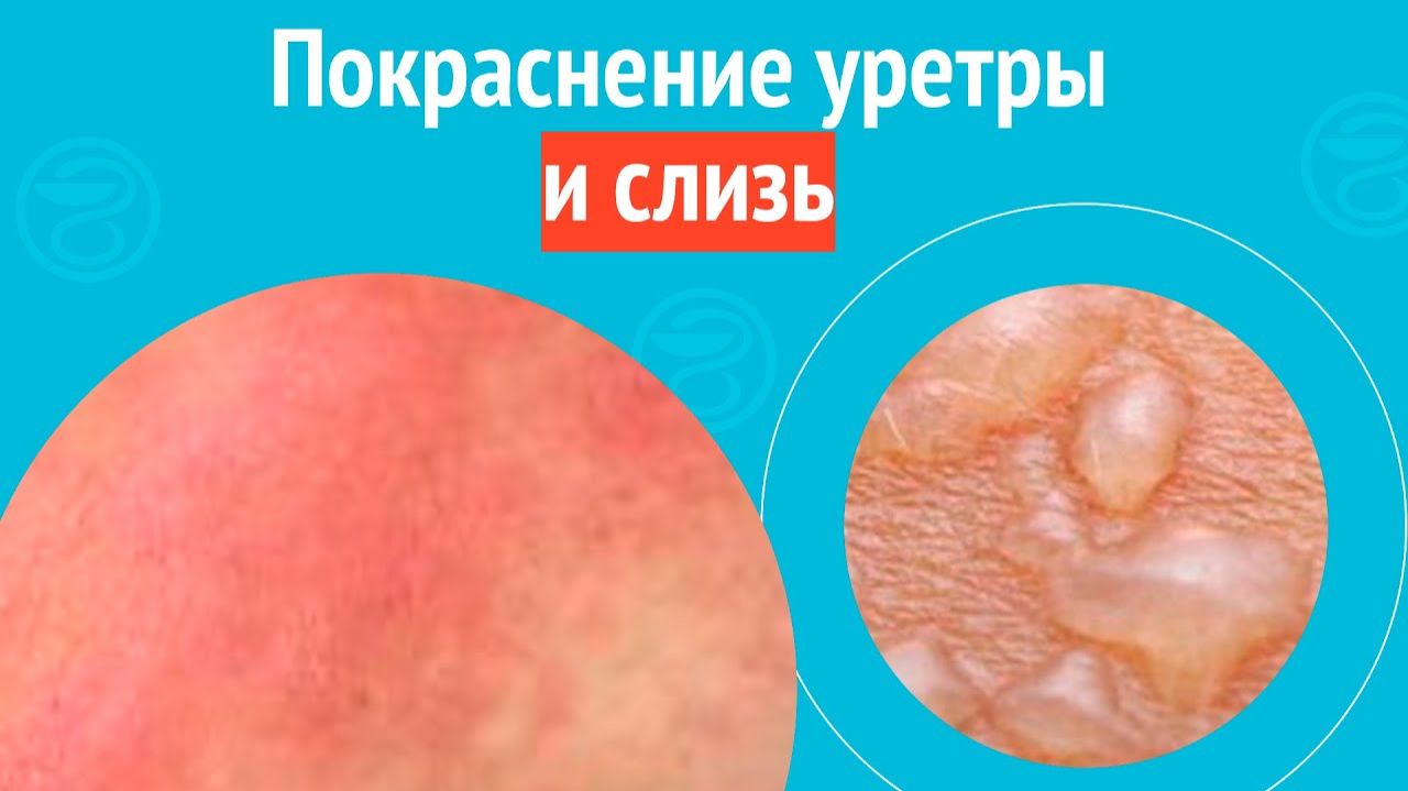 😡 Покраснение уретры и слизь. Клинический случай №1588 смотреть онлайн