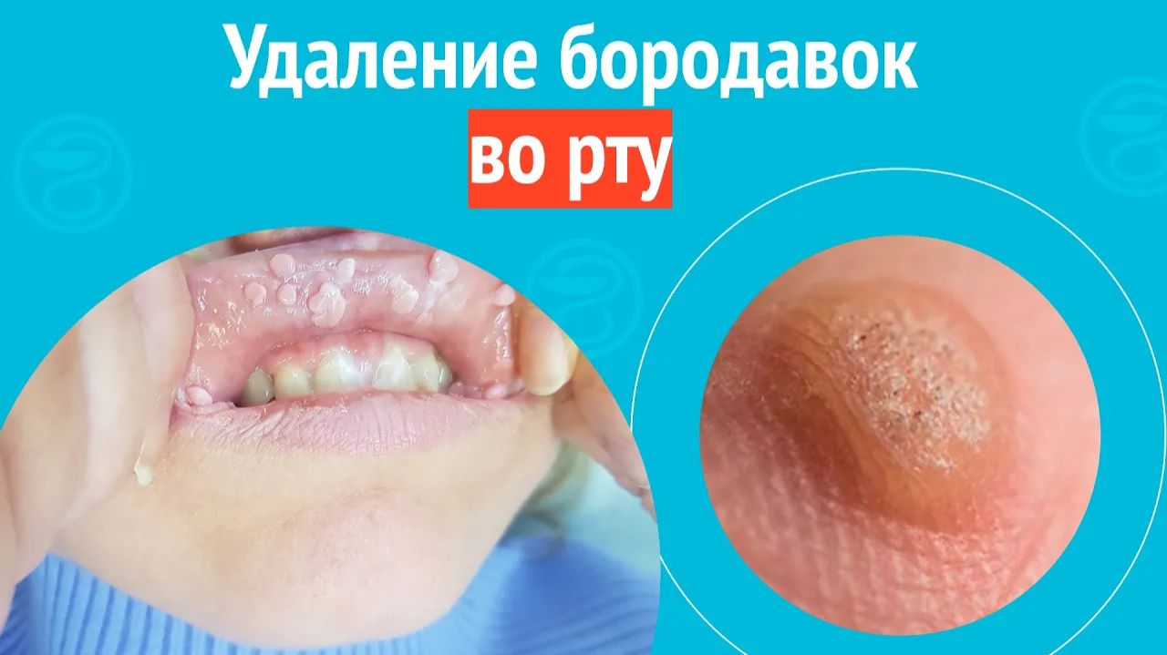 ✅ Удаление бородавок во рту. Клинический случай №1574 смотреть онлайн