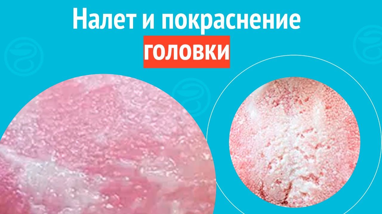 😡 Налет и покраснение головки. Клинический случай №1572 смотреть онлайн