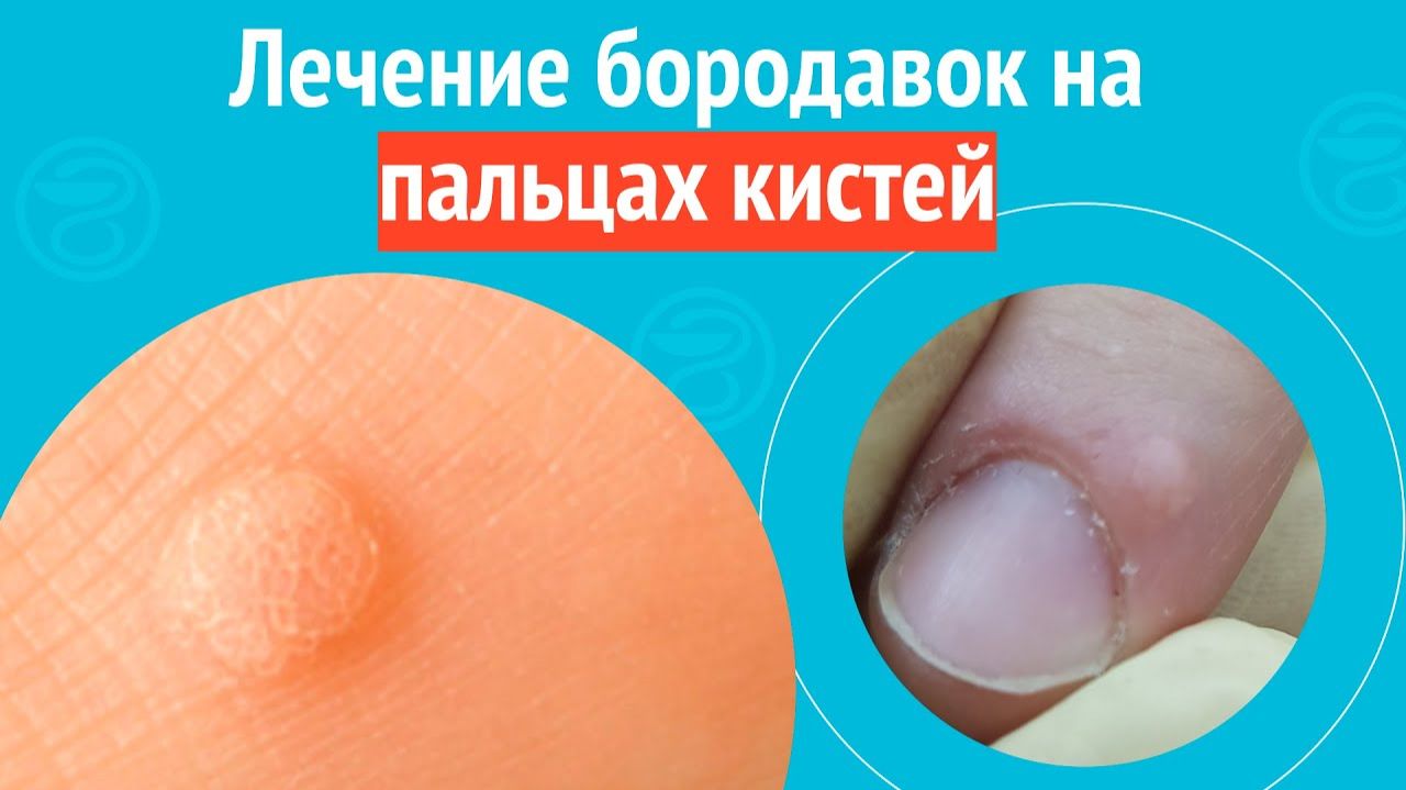 🖖 Лечение бородавок на пальцах кистей. Клинический случай №1577 смотреть онлайн