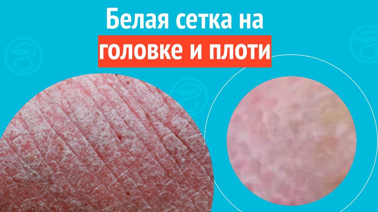 ⏹ Белая сетка на головке и плоти. Клинический случай №1579 смотреть онлайн