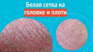 ⏹ Белая сетка на головке и плоти. Клинический случай №1579