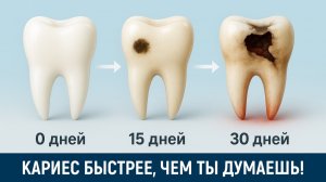 Что будет с твоим зубом, если не лечить кариес?