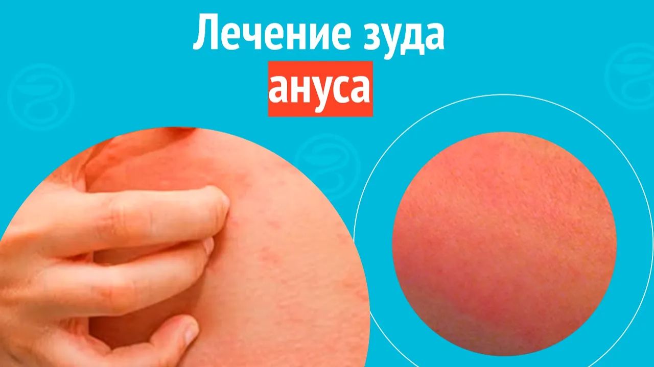 🩺 Лечение зуда ануса. Клинический случай №1575 смотреть онлайн