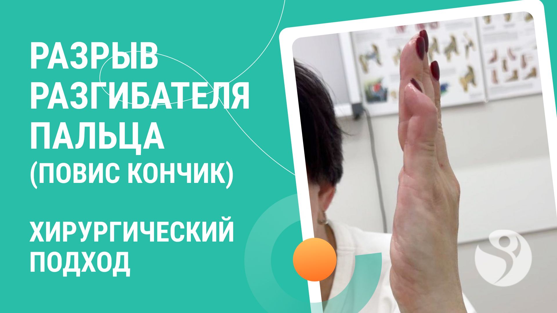 🧐 Разрыв разгибателя пальца (повис кончик). Хирургический подход