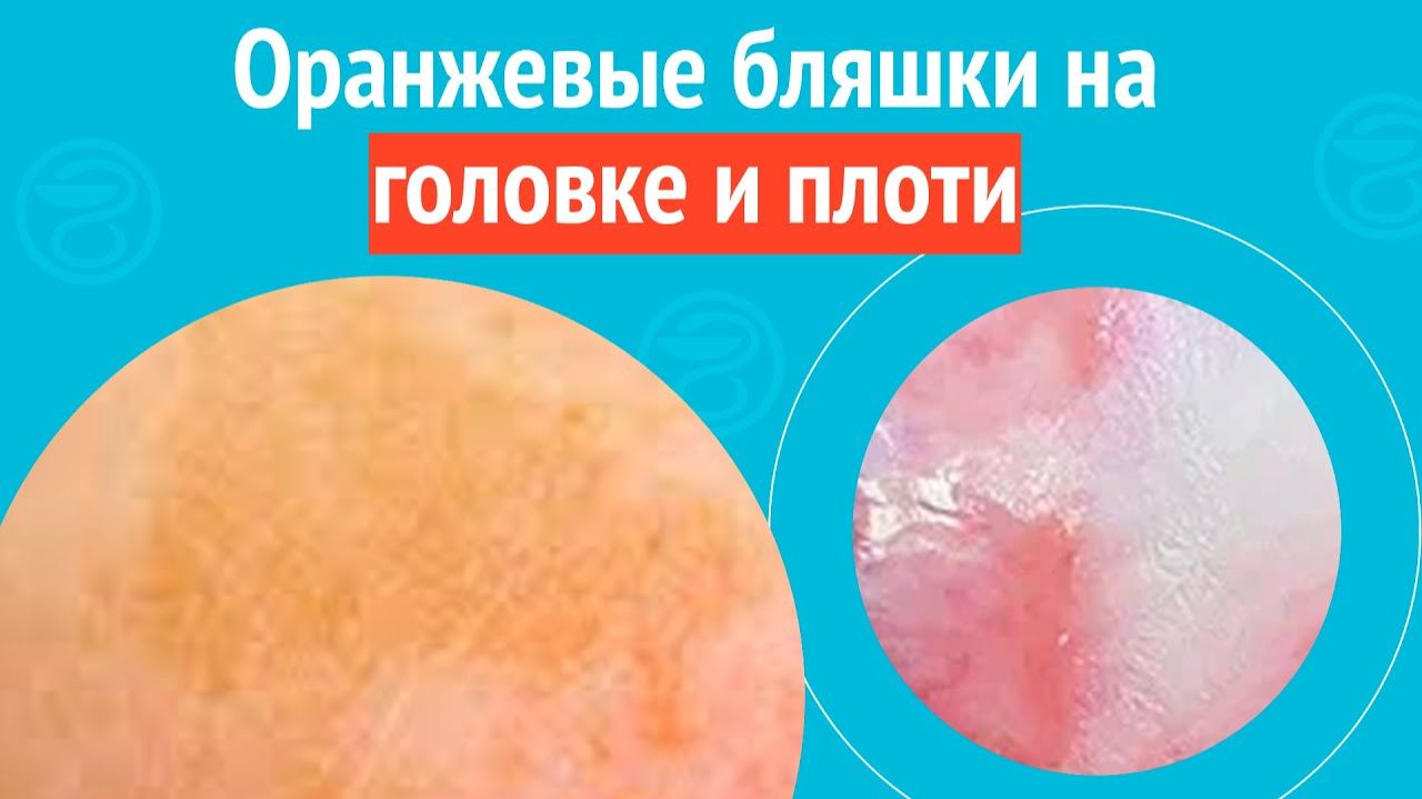 👉 Оранжевые бляшки на головке и плоти. Клинический случай №1583 смотреть онлайн
