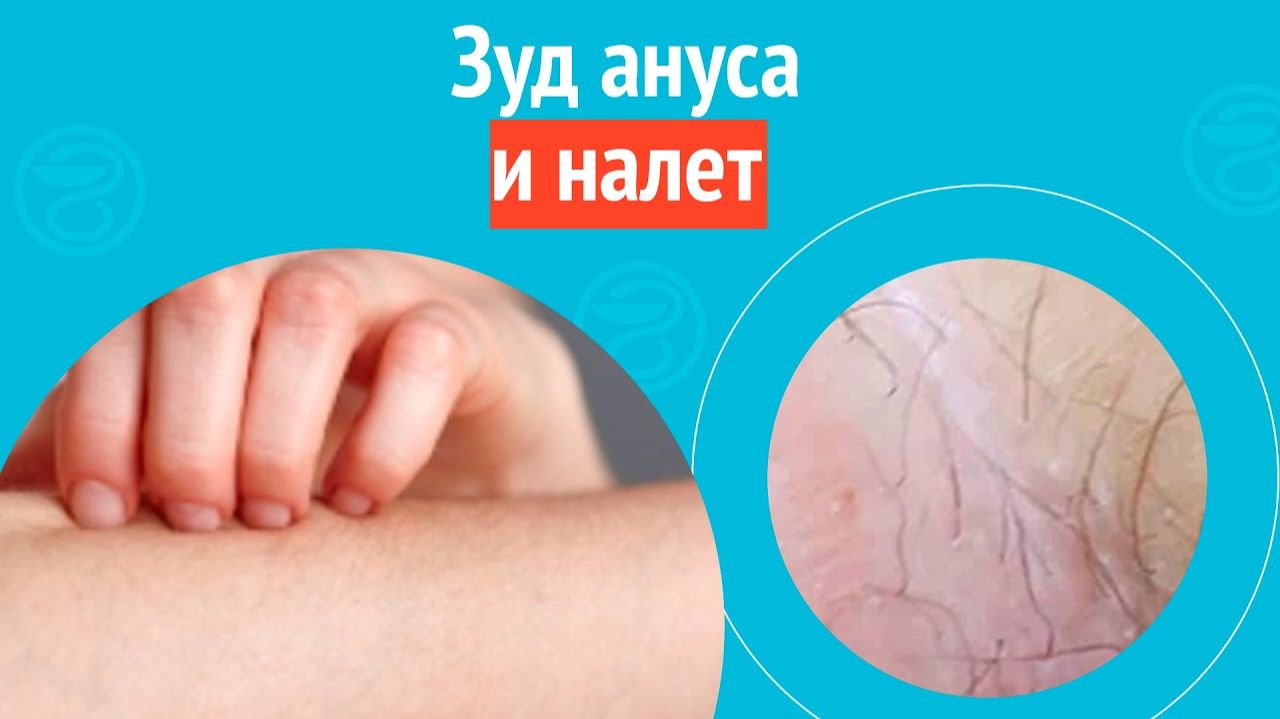 😨 Зуд ануса и налет. Клинический случай №1589 смотреть онлайн