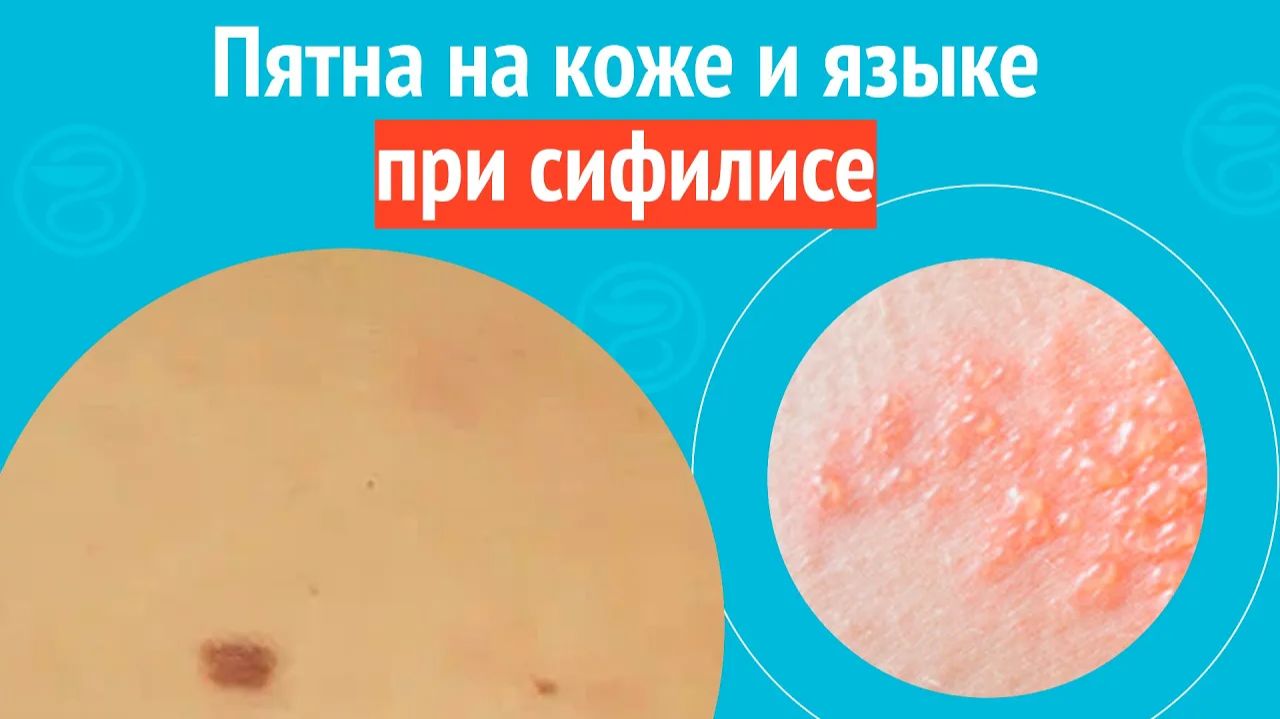☹️ Пятна на коже и языке при сифилисе. Клинический случай №1587 смотреть онлайн