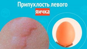 😢 Припухлость левого яичка. Клинический случай №1598