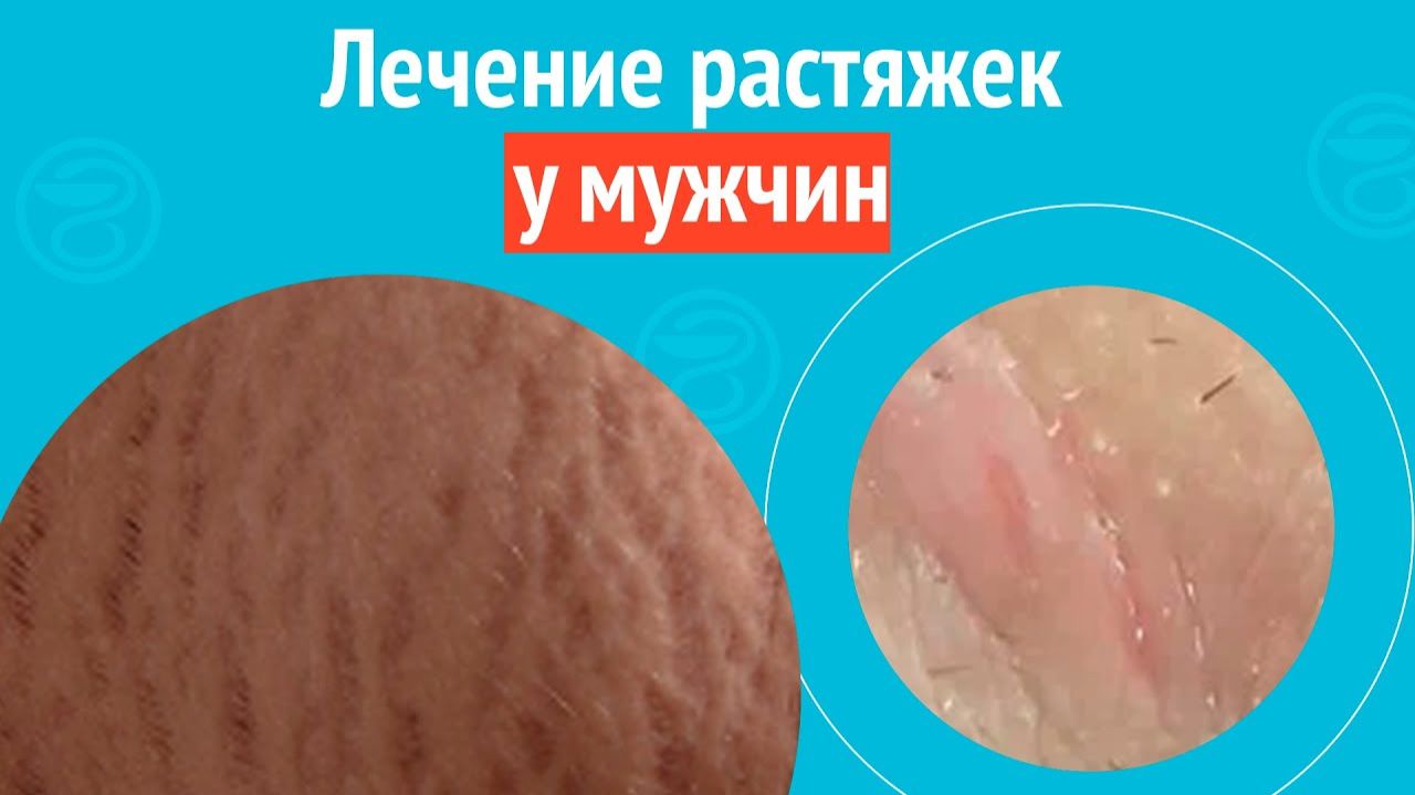👉 Лечение растяжек у мужчин. Клинический случай №1578 смотреть онлайн