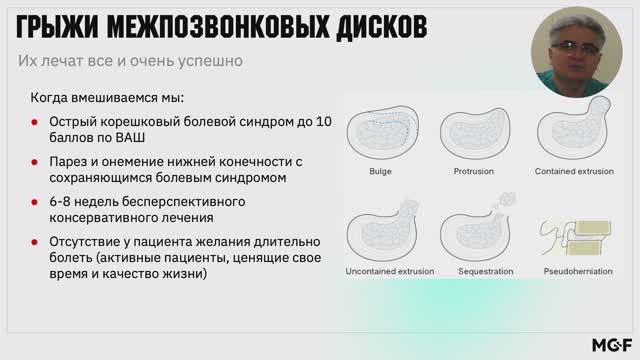 Эндоскопическое лечение грыжи диска и стеноза позвоночного канала смотреть онлайн