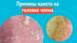 👉 Причины налета на головке члена. Клинический случай №1621