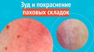 😡 Зуд и покраснение паховых складок. Клинический случай №1613