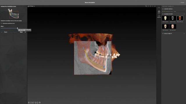 Дополнительный рабочий процесс – Аннотация нижнечелюстного нерва _ IPS CaseDesigner® Руководство смотреть онлайн