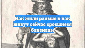 Как жили раньше и как живут сейчас сросшиеся близнецы