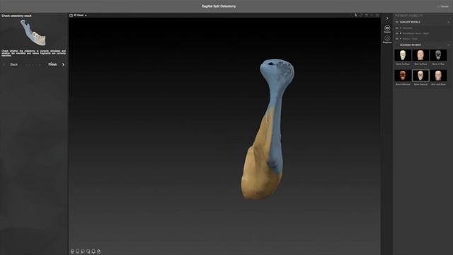 Рабочий процесс 5 - Создание виртуальных остеотомий _ IPS CaseDesigner® Руководство смотреть онлайн