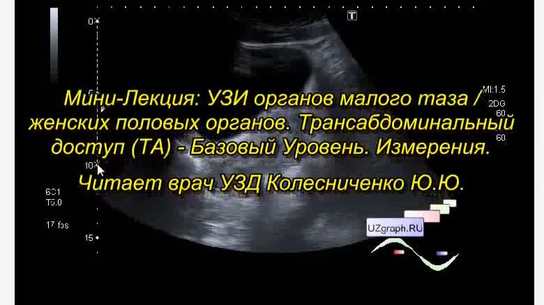 Лекция: УЗИ органов малого таза, Трансабдоминальный доступ (ТА) - Базовый Уровень смотреть онлайн