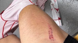 Бакуров пожаловался на травму ноги после удара Большунова на Кубке РФ