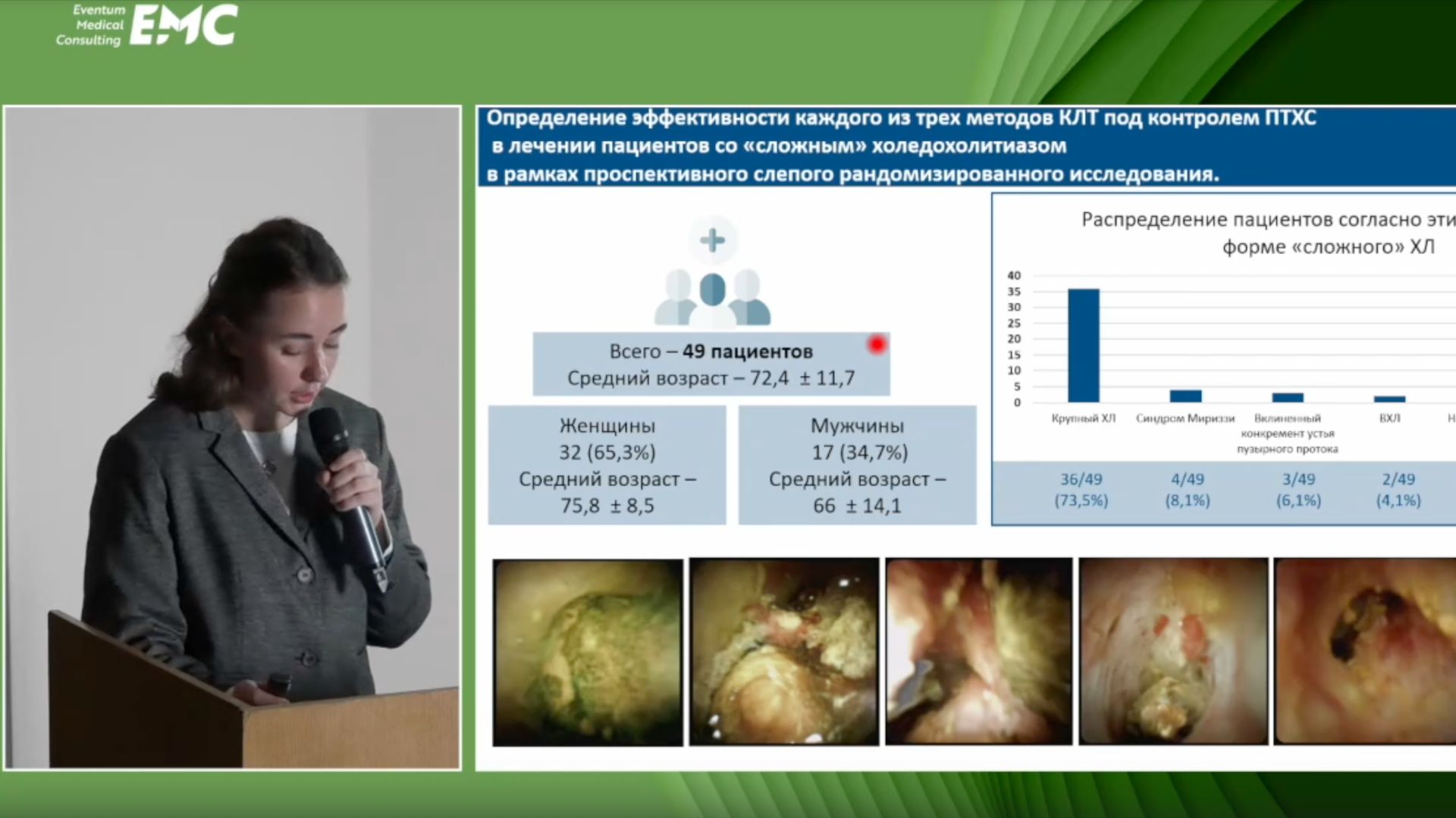 6 Мурашкина МВ Предварит результаты исследования эффективности литотрипсии в лечении холедохолитиаза