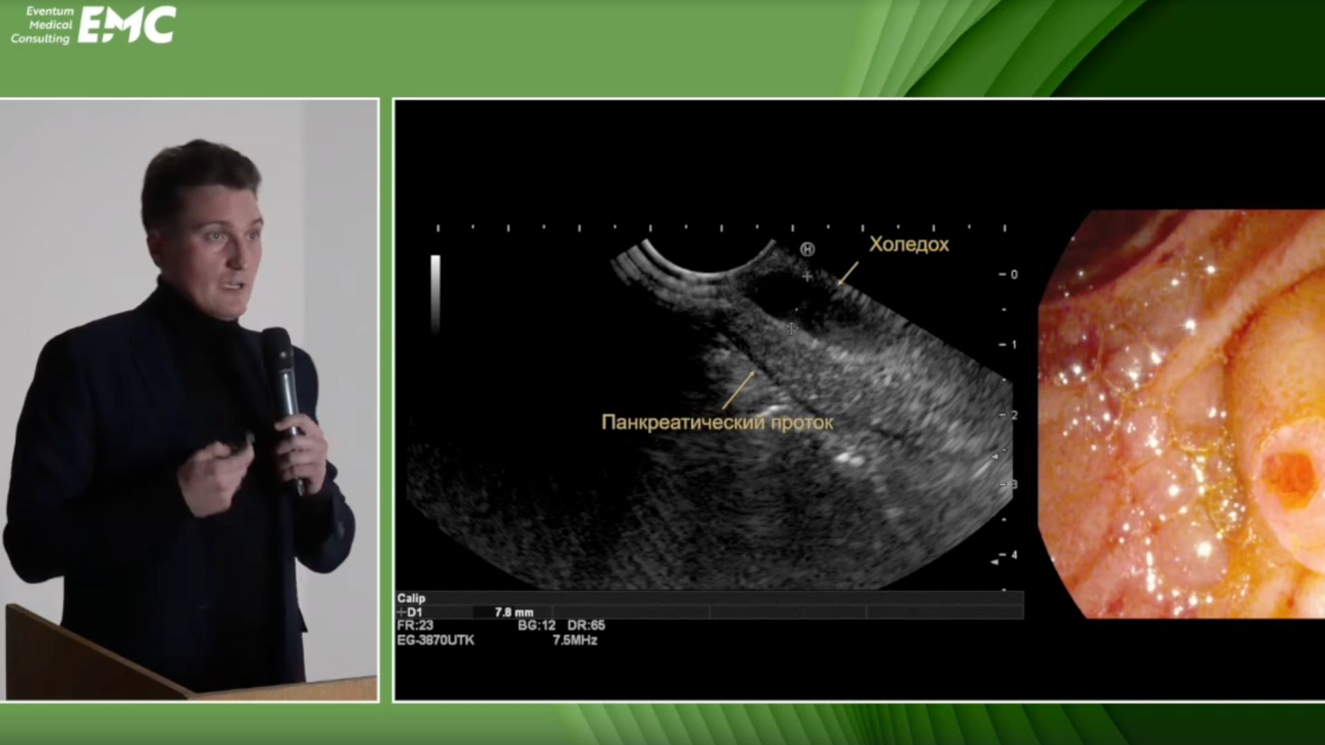 2 Макаров Д.В. эУЗИ как инструмент выбора лечебной тактики у экстренных пациентов с патологией ПБС