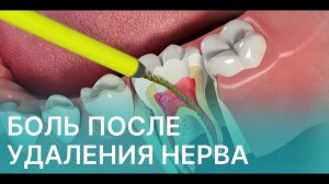 Болит зуб после удаления нерва - норма или тревога?