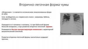 Чума. Лекция для студента и практикующего врача.