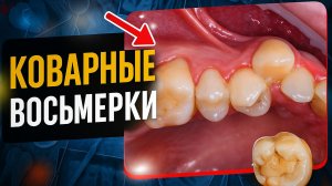 Удаляйте зубы мудрости