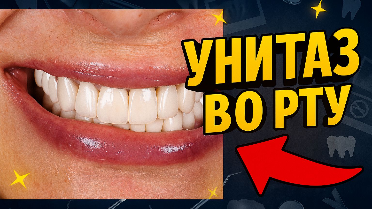 Белоснежные виниры