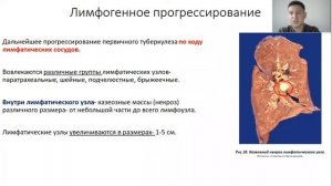 Туберкулез легких. Лекция для студента и практикующего врача.